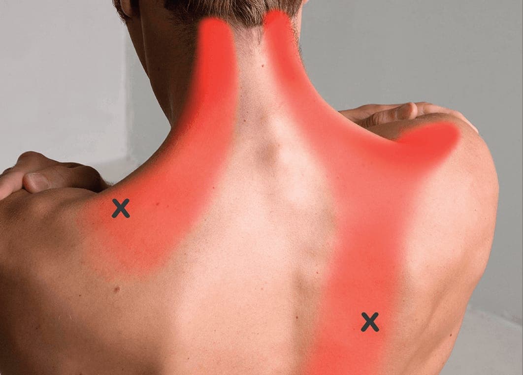 Trigger Point Injection Therapy